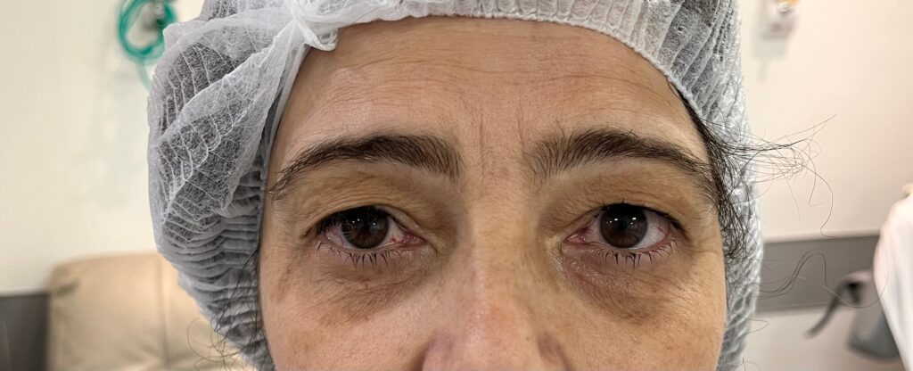 Paciente com excesso de pele em pálpebra e deseja realizar a blefaroplastia